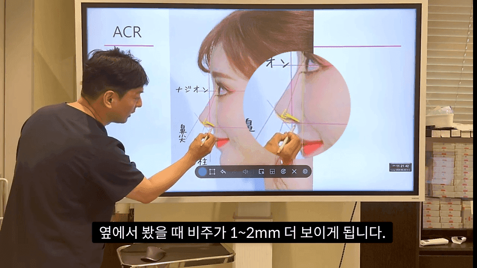 자연스러운 코끝은 왜 사각형일까 — ACR·비순각 90도와 돌출입 완화 효과 관련 이미지 9/35