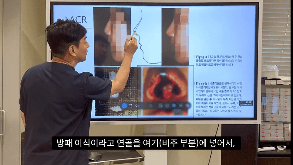 자연스러운 코끝은 왜 사각형일까 — ACR·비순각 90도와 돌출입 완화 효과 관련 이미지 22/35