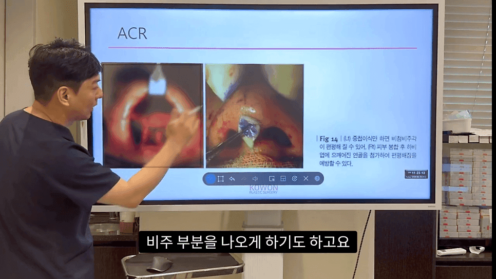 자연스러운 코끝은 왜 사각형일까 — ACR·비순각 90도와 돌출입 완화 효과 관련 이미지 23/35
