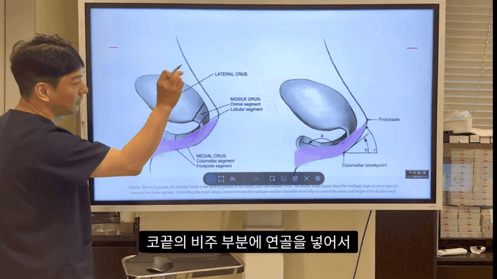 자연스러운 코끝은 왜 사각형일까 — ACR·비순각 90도와 돌출입 완화 효과 관련 이미지 24/35