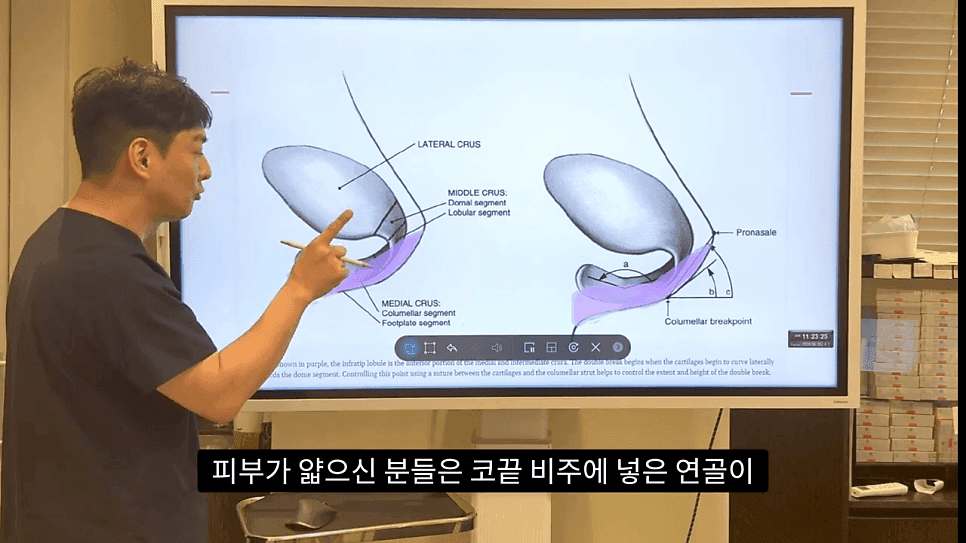 자연스러운 코끝은 왜 사각형일까 — ACR·비순각 90도와 돌출입 완화 효과 관련 이미지 26/35
