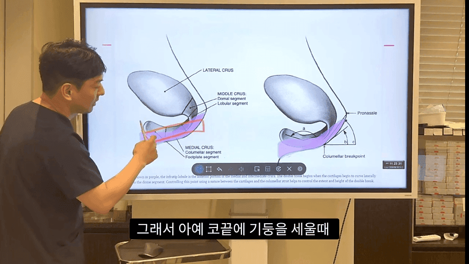 자연스러운 코끝은 왜 사각형일까 — ACR·비순각 90도와 돌출입 완화 효과 관련 이미지 27/35