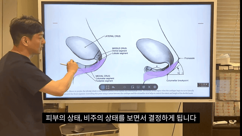 자연스러운 코끝은 왜 사각형일까 — ACR·비순각 90도와 돌출입 완화 효과 관련 이미지 29/35