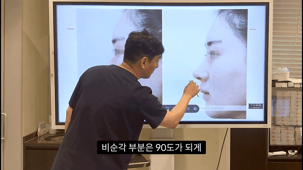 자연스러운 코끝은 왜 사각형일까 — ACR·비순각 90도와 돌출입 완화 효과 관련 이미지 34/35