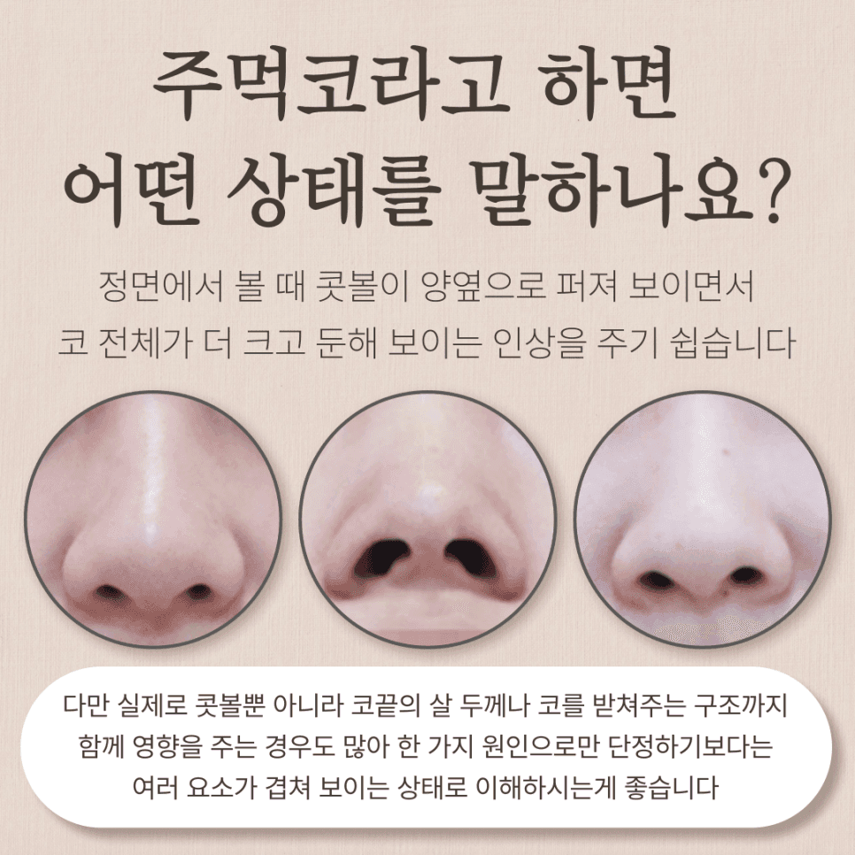 ฉันมีจมูกใหญ่ป่องการลดปีกจมูกอย่างเดียวจะเพียงพอหรือไม่? — เกณฑ์ในการแยกแยะว่าปัญหาอยู่ที่ปีกจมูกเพียงอย่างเดียว ภาพประกอบ 2/7