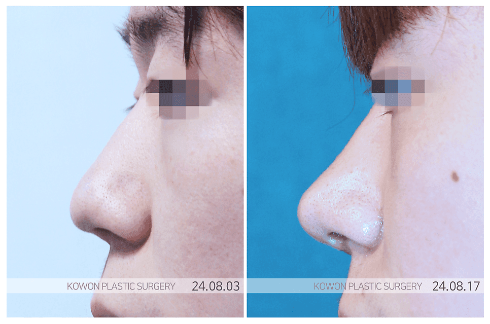 콧볼성형, 실패를 줄이려면 — 외측·내측 절개의 차이와 전체 구조를 함께 보는 이유 관련 이미지 3/8