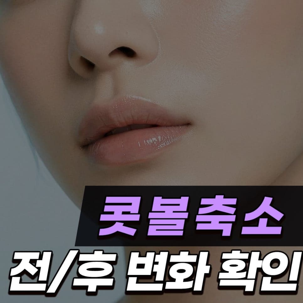 콧볼축소수술 전후, 콧구멍 노출과 들린코 느낌은 얼마나 달라질까 — 절개 방식 질문 세 가지 관련 이미지 1/11