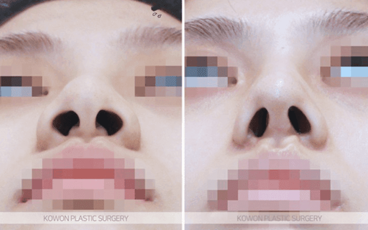 ก่อนและหลังการผ่าตัดการลดปีกจมูก: รูจมูกรูจมูกและรูปจมูกเชิดเปลี่ยนแปลงไปมากน้อยแค่ไหน? — สามคำถามเกี่ยวกับวิธีการผ่าตัด ภาพที่เกี่ยวข้อง 5/11