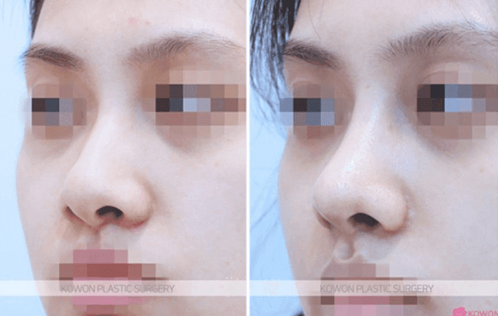 ก่อนและหลังการผ่าตัดการลดปีกจมูก: การเปิดของรูจมูกและความรู้สึกจมูกเชิดเปลี่ยนแปลงไปมากน้อยแค่ไหน? — สามคำถามเกี่ยวกับวิธีการผ่าตัด ภาพที่เกี่ยวข้อง 9/11