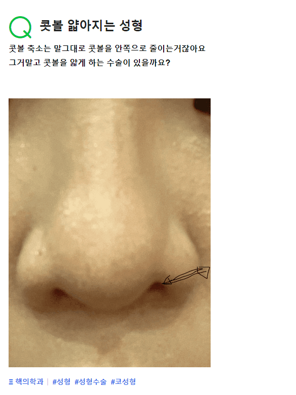넓은 콧볼의 살을 얇게 줄일 수 있나요 — 두께와 폭을 먼저 구분하는 이유 관련 이미지 2/2