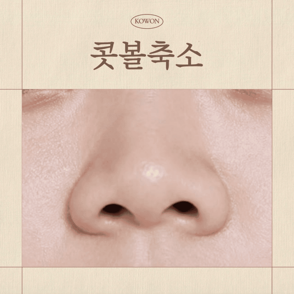 Image 1/6 for alar reduction — what to check first? Distinguishing flared, bulbous, and large-nostril types