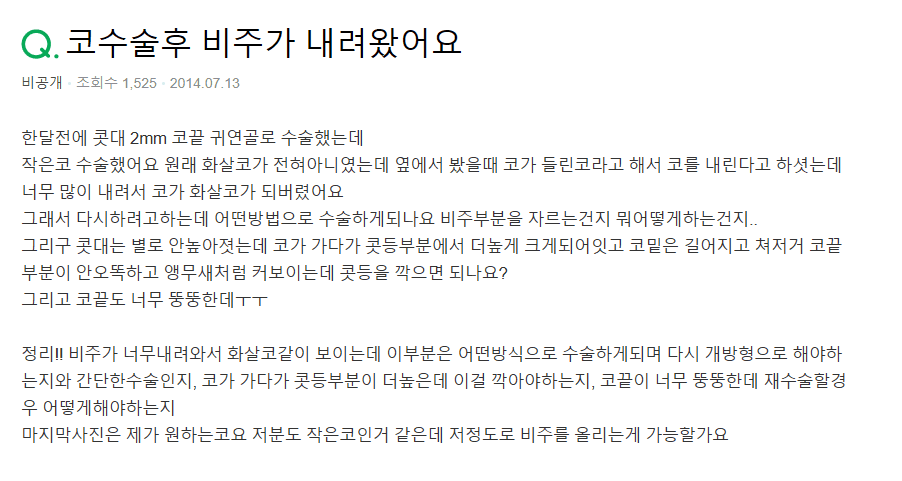 코수술 후 화살코가 됐다면 — 들린 코 교정 뒤 비주가 내려온 경우의 재수술 Q&A 관련 이미지 2/8