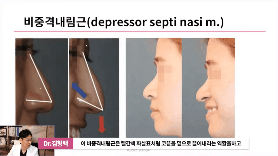 화살코성형 후 다시 처진코가 되는 원인 — 코끝내림근과 상순비익올림근 이야기 관련 이미지 3/11