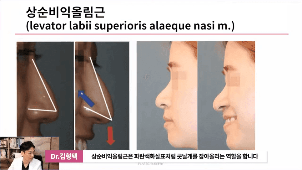 화살코성형 후 다시 처진코가 되는 원인 — 코끝내림근과 상순비익올림근 이야기 관련 이미지 4/11