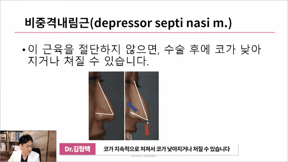 화살코성형 후 다시 처진코가 되는 원인 — 코끝내림근과 상순비익올림근 이야기 관련 이미지 5/11