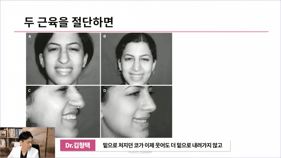 화살코성형 후 다시 처진코가 되는 원인 — 코끝내림근과 상순비익올림근 이야기 관련 이미지 7/11