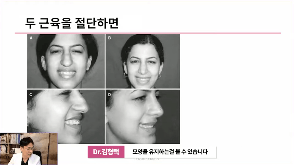 화살코성형 후 다시 처진코가 되는 원인 — 코끝내림근과 상순비익올림근 이야기 관련 이미지 8/11