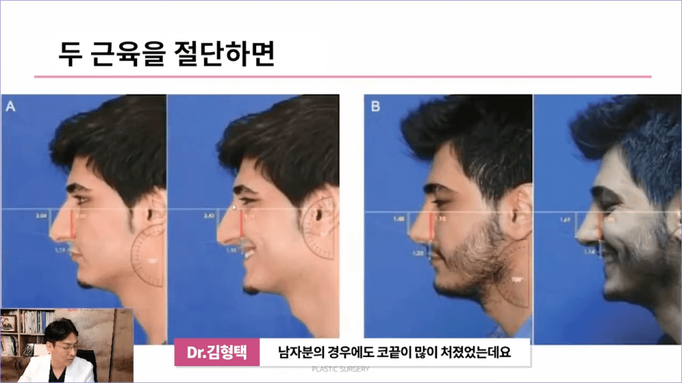 화살코성형 후 다시 처진코가 되는 원인 — 코끝내림근과 상순비익올림근 이야기 관련 이미지 10/11