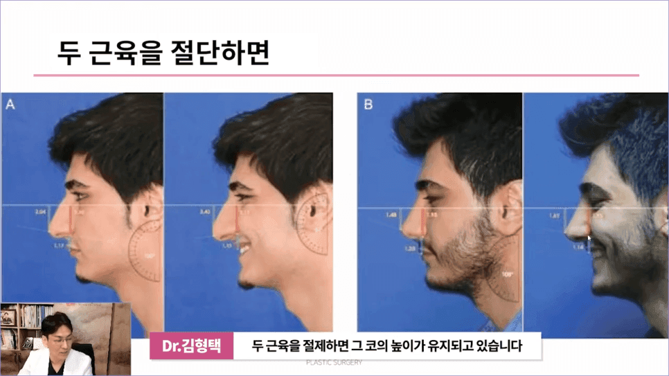 화살코성형 후 다시 처진코가 되는 원인 — 코끝내림근과 상순비익올림근 이야기 관련 이미지 11/11