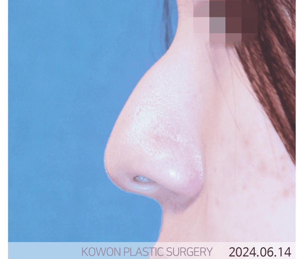 การผ่าตัดจมูกปลายตก: เหตุผลที่คุณไม่ควรแค่โกนส่วนที่นูนออก — ภาพประกอบเกี่ยวกับการออกแบบรูปทรงและโครงสร้างรองรับ 2/5