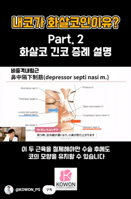 화살코 교정과 긴코성형 — 수술 후에도 코가 다시 처지지 않으려면 근육까지 봐야 하는 이유 관련 이미지 1/15