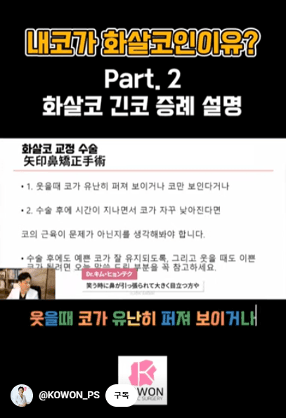 화살코 교정과 긴코성형 — 수술 후에도 코가 다시 처지지 않으려면 근육까지 봐야 하는 이유 관련 이미지 3/15