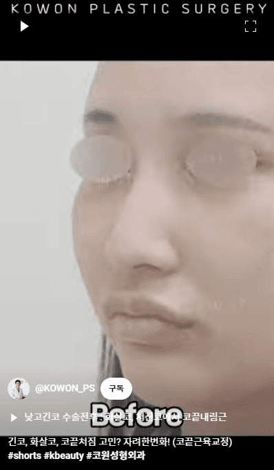 화살코 교정과 긴코성형 — 수술 후에도 코가 다시 처지지 않으려면 근육까지 봐야 하는 이유 관련 이미지 8/15