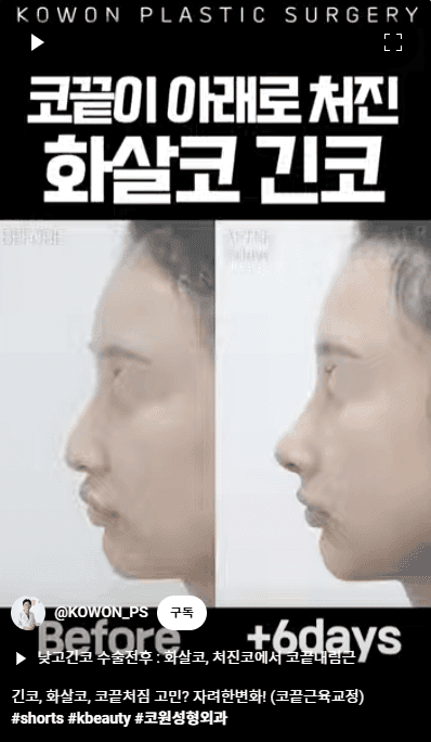 화살코 교정과 긴코성형 — 수술 후에도 코가 다시 처지지 않으려면 근육까지 봐야 하는 이유 관련 이미지 10/15