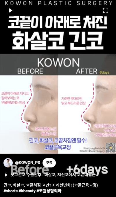 화살코 교정과 긴코성형 — 수술 후에도 코가 다시 처지지 않으려면 근육까지 봐야 하는 이유 관련 이미지 11/15