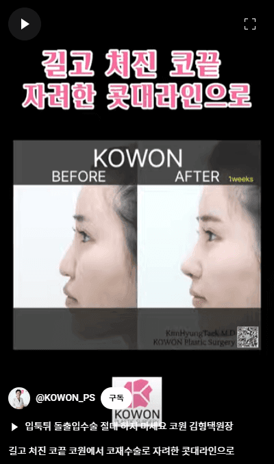 화살코 교정과 긴코성형 — 수술 후에도 코가 다시 처지지 않으려면 근육까지 봐야 하는 이유 관련 이미지 12/15