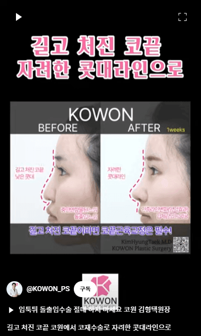 화살코 교정과 긴코성형 — 수술 후에도 코가 다시 처지지 않으려면 근육까지 봐야 하는 이유 관련 이미지 13/15