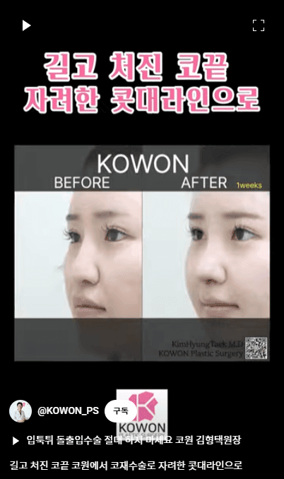 화살코 교정과 긴코성형 — 수술 후에도 코가 다시 처지지 않으려면 근육까지 봐야 하는 이유 관련 이미지 14/15