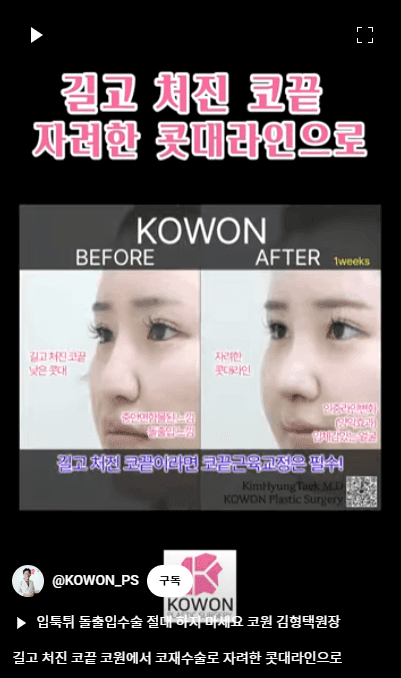 화살코 교정과 긴코성형 — 수술 후에도 코가 다시 처지지 않으려면 근육까지 봐야 하는 이유 관련 이미지 15/15
