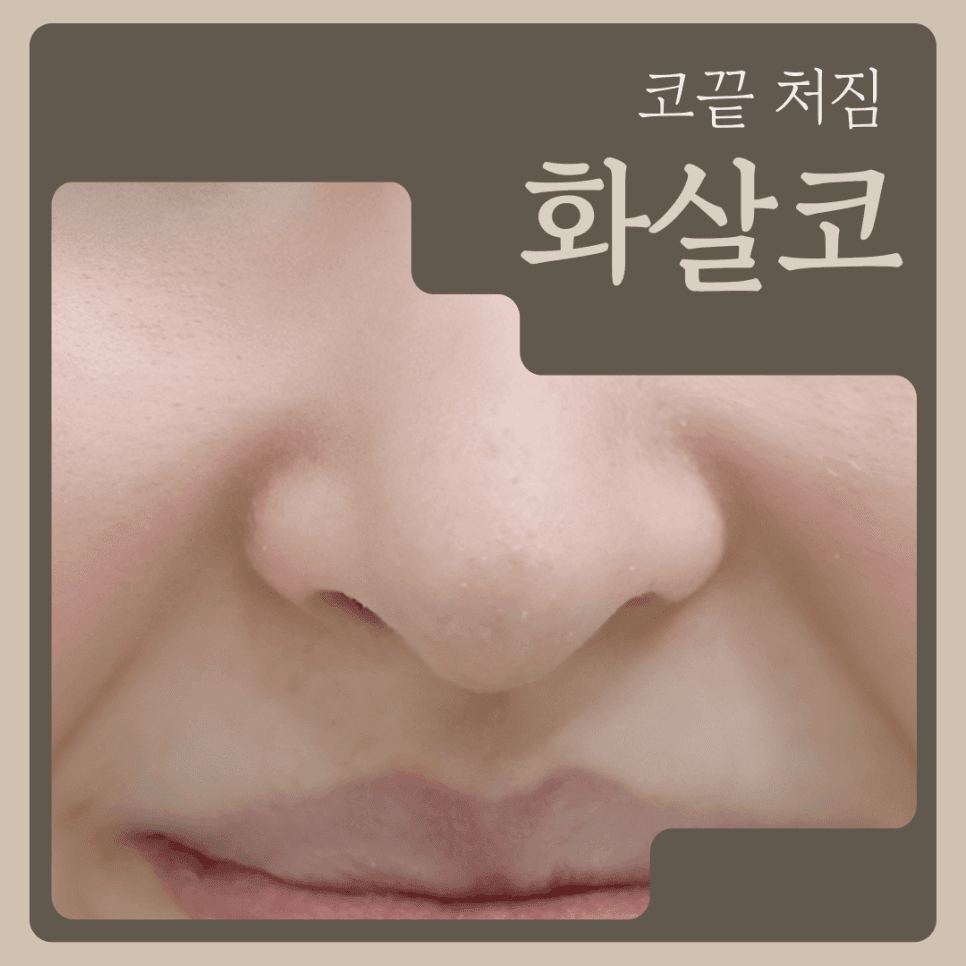 鼻先の垂れ、鼻先だけ矯正すればよいのか — 二つの表情筋と筋肉調節術の話 関連画像 1/7