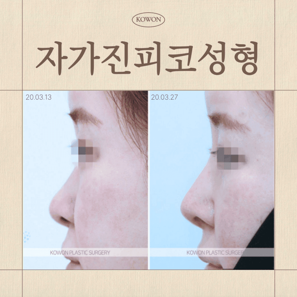 자가진피코성형과 자가조직코수술, 다 같은 건가요 — 세 방식의 차이와 판단 기준 관련 이미지 1/6