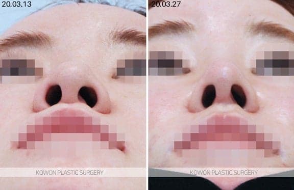 자가진피코성형과 자가조직코수술, 다 같은 건가요 — 세 방식의 차이와 판단 기준 관련 이미지 6/6