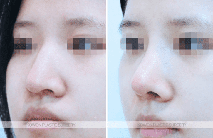 자가늑 코수술, 맞춤보형물(RIBFIT™ 리브핏)로 하면 무엇이 다른가요? 관련 이미지 4/5