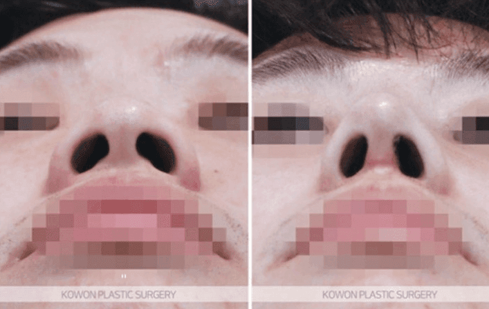 การผ่าตัดจมูก กระดูกอ่อนซี่โครงของตนเองแตกต่างจากการใช้อิมแพลนต์แบบสั่งทำพิเศษ (RIBFIT™) อย่างไร? ภาพที่เกี่ยวข้อง 5/5