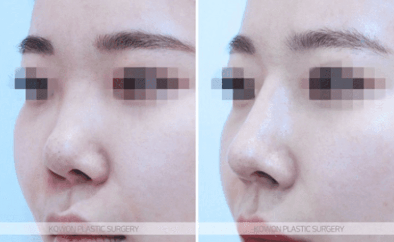자가늑연골 코수술은 자연스러울까 — 처진 코끝과 낮은 미간을 함께 정리한 과정 관련 이미지 4/10
