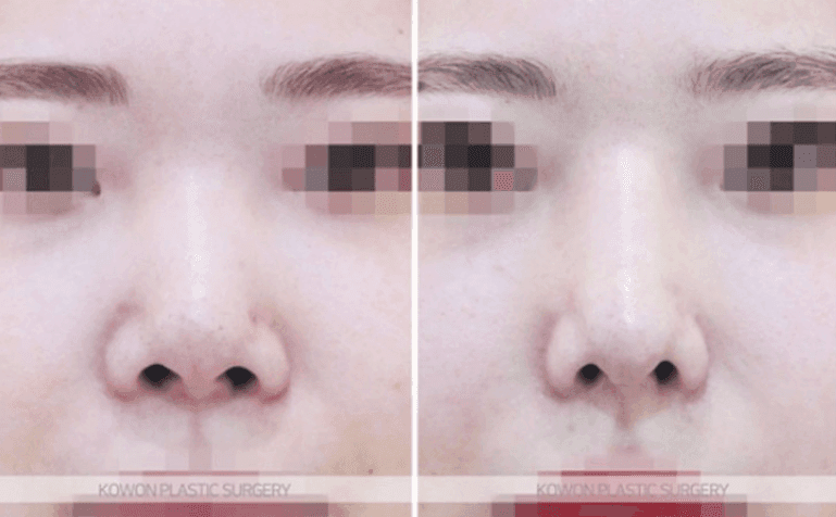 자가늑연골 코수술은 자연스러울까 — 처진 코끝과 낮은 미간을 함께 정리한 과정 관련 이미지 6/10