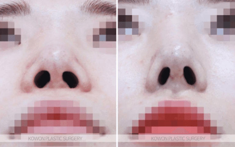 การผ่าตัดจมูก กระดูกอ่อนซี่โครงของตนเองดูเป็นธรรมชาติหรือไม่? — ภาพประกอบเกี่ยวกับการแก้ไขปลายจมูกที่หย่อนคล้อยและหว่างคิ้วที่ต่ำ 7/10