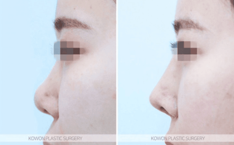 การผ่าตัดจมูก กระดูกอ่อนซี่โครงของตนเองดูเป็นธรรมชาติหรือไม่? — ภาพประกอบแสดงขั้นตอนการแก้ไขปลายจมูกหย่อนคล้อยและสันคิ้วต่ำ 8/10