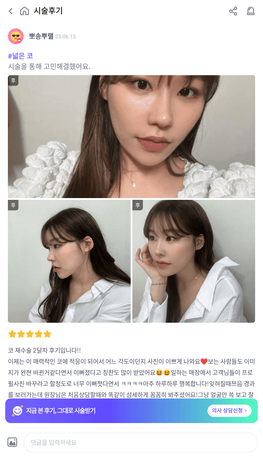 ศัลยกรรมแก้จมูกและมุมระหว่างจมูกกับริมฝีปาก กระดูกอ่อนซี่โครงของตนเอง— ภาพประกอบแสดงขั้นตอนการประเมินกรณีที่จมูกดูต่ำและปากดูยื่นออกมา 4/15