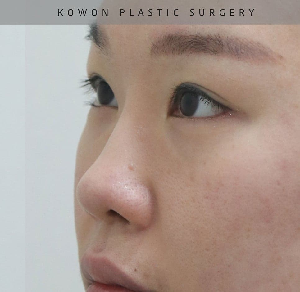 자가늑 코재수술과 비순각 교정 — 코가 낮아 보이고 입이 나와 보였던 사례의 판단 과정 관련 이미지 5/15