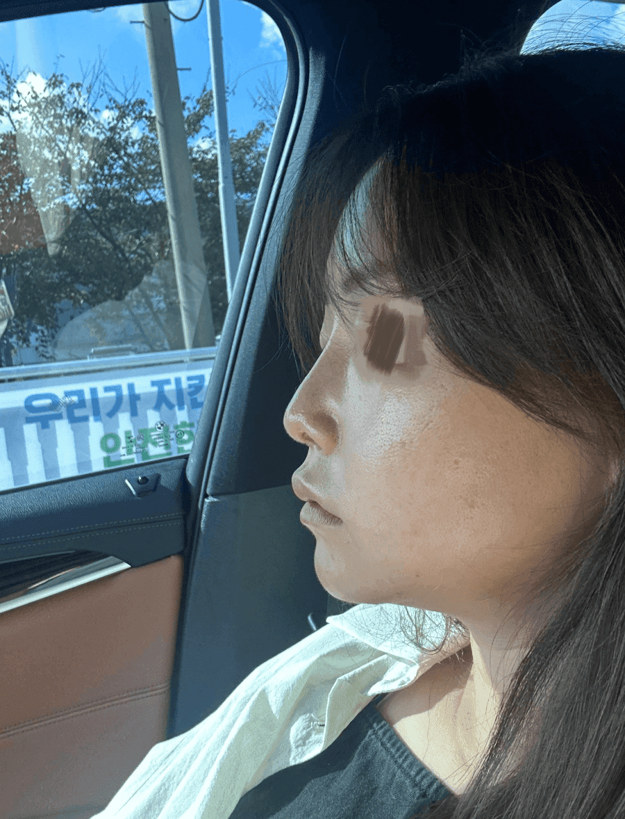코끝 처짐이 반복된 코, 자가늑연골 재수술로 계획한 이유 — 실리콘 교체와 귀연골 보강까지 관련 이미지 1/9
