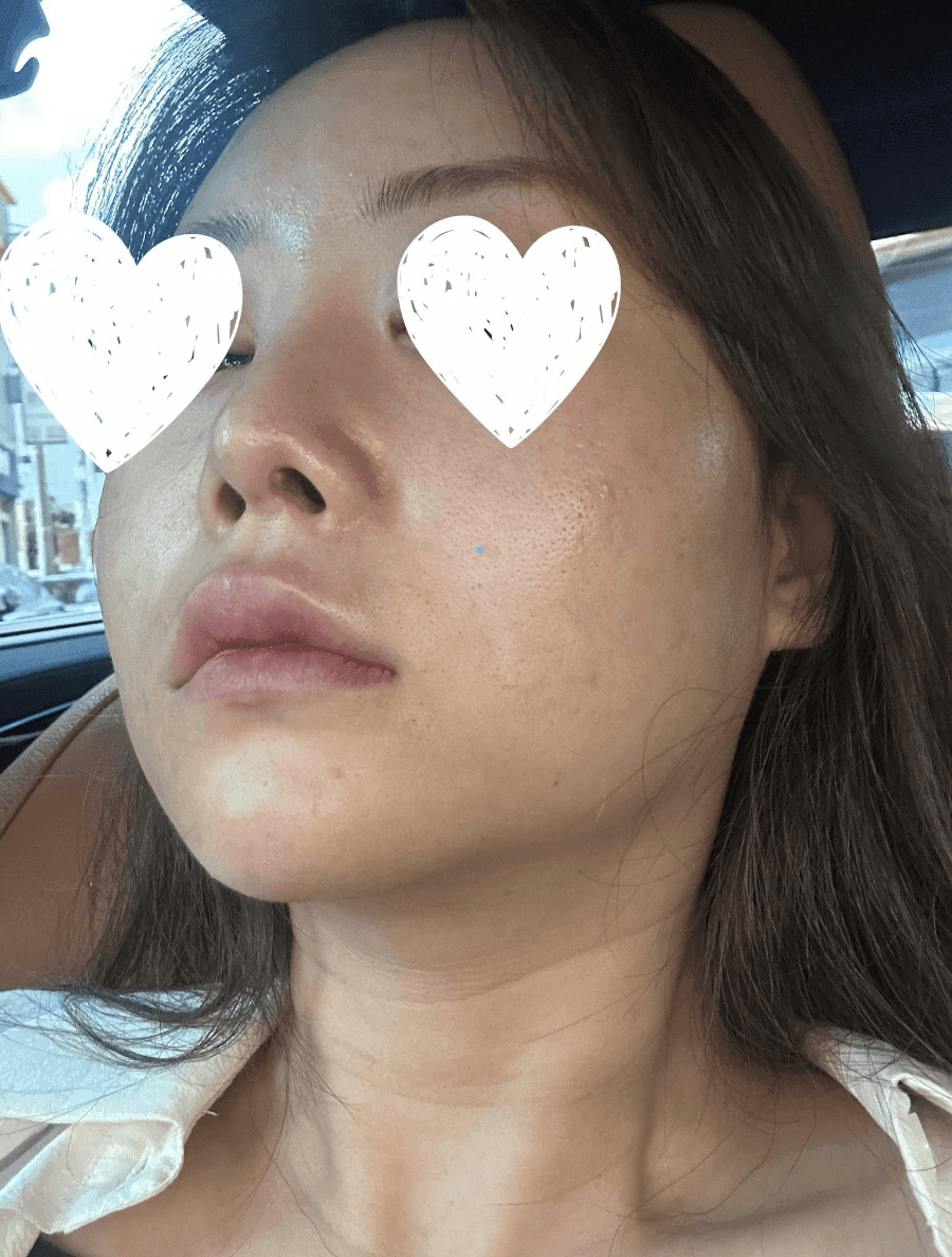 코끝 처짐이 반복된 코, 자가늑연골 재수술로 계획한 이유 — 실리콘 교체와 귀연골 보강까지 관련 이미지 2/9