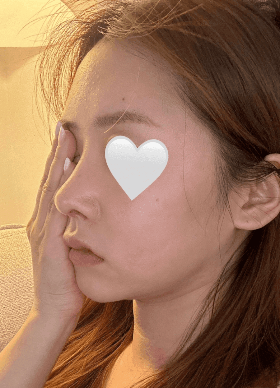 코끝 처짐이 반복된 코, 자가늑연골 재수술로 계획한 이유 — 실리콘 교체와 귀연골 보강까지 관련 이미지 3/9
