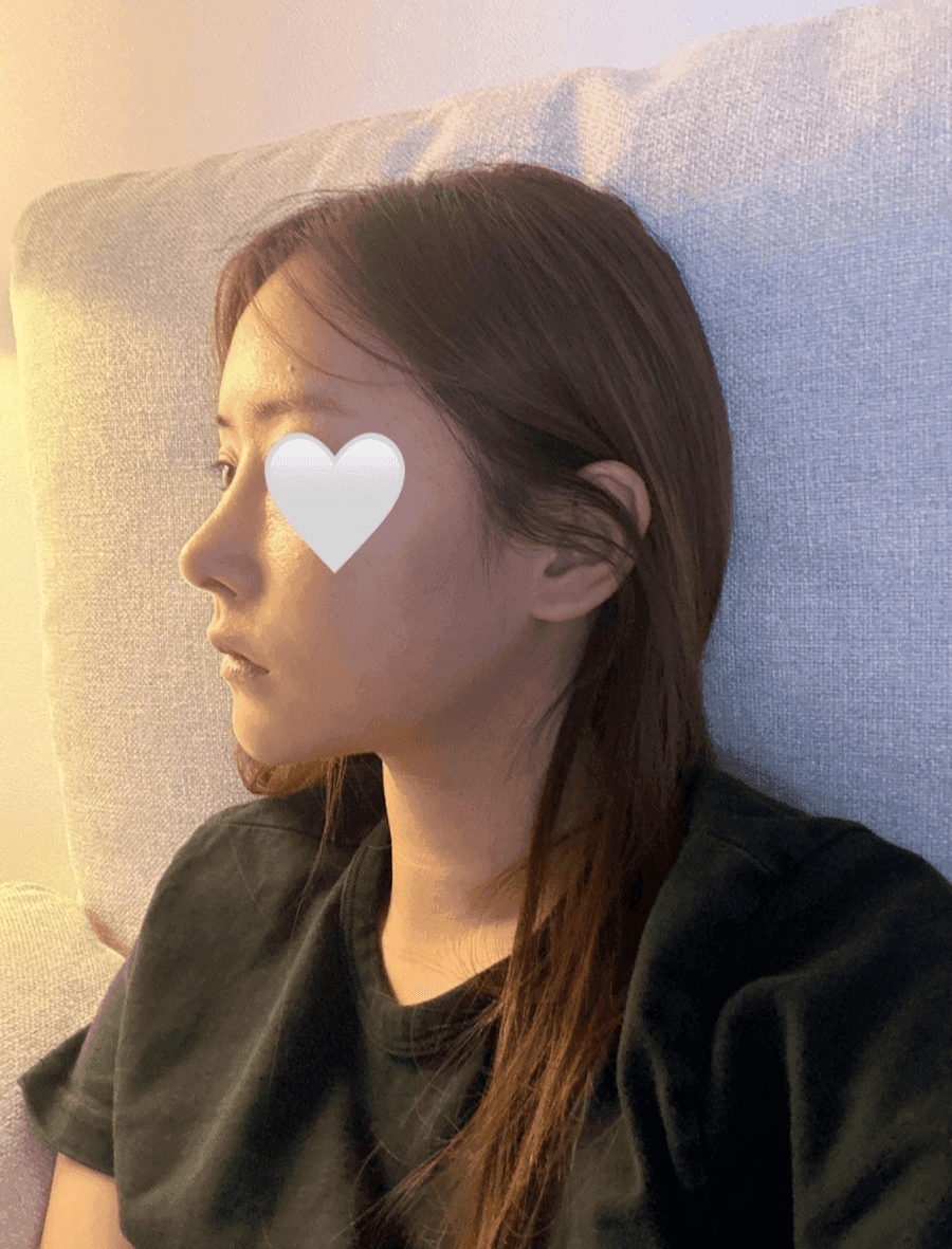 코끝 처짐이 반복된 코, 자가늑연골 재수술로 계획한 이유 — 실리콘 교체와 귀연골 보강까지 관련 이미지 4/9