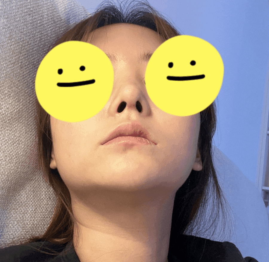 코끝 처짐이 반복된 코, 자가늑연골 재수술로 계획한 이유 — 실리콘 교체와 귀연골 보강까지 관련 이미지 5/9