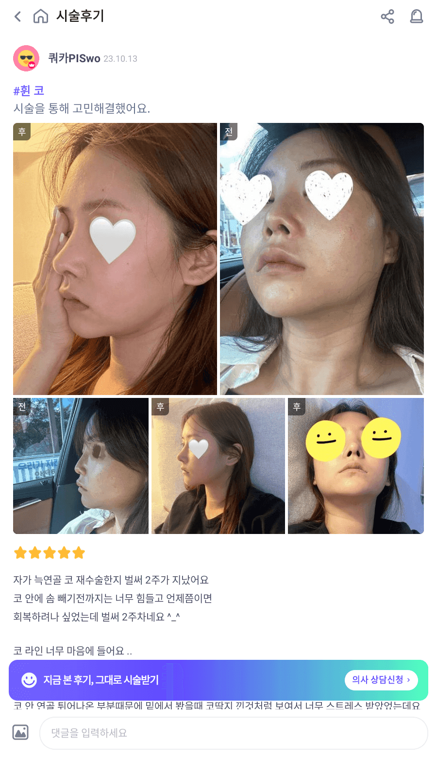 코끝 처짐이 반복된 코, 자가늑연골 재수술로 계획한 이유 — 실리콘 교체와 귀연골 보강까지 관련 이미지 6/9